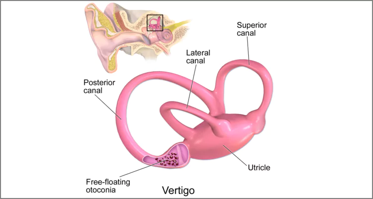 Image of inner ear showing semi-circular canals and utricle. blog on balance disorders
