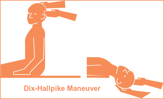 Image of dix-hallpike maneuver. blog on balance disorders